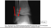 АР х-гаy
Fig 1: Nenopoulos et al. "Rotational injuries of the distal tibial growth plate" Journal of Orthopaedic
Science 8(6):784-8 2003 DOI:10.1007/s00776-003-0723-x accessed 10/1/2021
