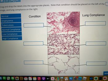 Drag and drop the labels into the appropriate places. Note that condition should be placed on the left of the
image, and lung compliance on the right.
Normal
Emphysema
Tuberculosis
Normal Compliance
Low Compliance
High Compliance
84
19
Condition
e tv
Lung Compliance
MOR