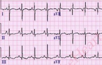 Answered: Identify the axis: Normal axis Right… | bartleby