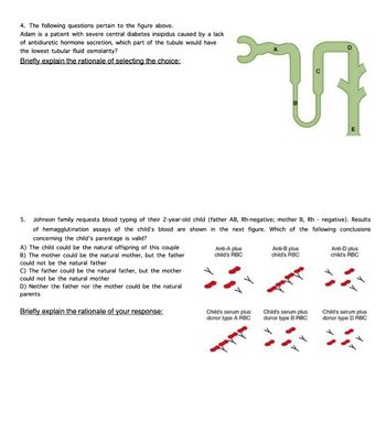 4. The following questions pertain to the figure above.
Adam is a patient with severe central diabetes insipidus caused by a lack
of antidiuretic hormone secretion, which part of the tubule would have
the lowest tubular fluid osmolarity?
Briefly explain the rationale of selecting the choice:
5.
Johnson family requests blood typing of their 2-year-old child (father AB, Rh-negative; mother B, Rh negative). Results
of hemagglutination assays of the child's blood are shown in the next figure. Which of the following conclusions
concerning the child's parentage is valid?
A) The child could be the natural offspring of this couple
B) The mother could be the natural mother, but the father
could not be the natural father
ก
C) The father could be the natural father, but the mother
could not be the natural mother
D) Neither the father nor the mother could be the natural
parents
Briefly explain the rationale of your response:
Anti-A plus
child's RBC
Child's serum plus
donor type A RBC
Anti-B plus
child's RBC
Child's serum plus
donor type B RBC
Anti-D plus
child's RBC
Child's serum plus
donor type D RBC