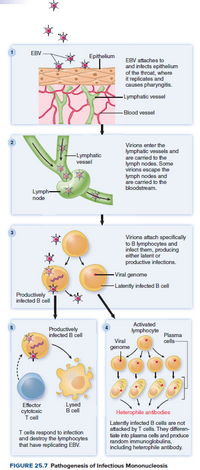 EBV
Epithelium
EBV attaches to
and infects epithelium
of the throat, where
it replicates and
causes pharyngitis.
-Lymphatic vessel
- Blood vessel
Virions enter the
lymphatic vessels and
are carried to the
lymph nodes. Some
virions escape the
lymph nodes and
are carried to the
bloodstream.
-Lymphatic
vessel
Lymph
node
Virions attach specifically
to B lymphocytes and
infect them, producing
either latent or
productive infections.
Viral genome
-Latently infected B cell
Productively
infected B cell
Productively
infected B cell
Activated
lymphocyte
Plasma
cells
Viral
%24
genome
Lysed
B cell
Effector
cytotoxic
T cell
Heterophile antibodies
T cells respond to infection
and destroy the lymphocytes
that have replicating EBV.
Latently infected B cells are not
attacked by T cells. They differen-
tiate into plasma cells and produce
random immunoglobulins,
including heterophile antibody.
FIGURE 25.7 Pathogenesis of Infectious Mononucleosis
