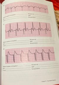 PR interval
ythm (egular or irregular)
QRS:
Interpretation:
Pare
Ehychm (regular or irregular):
Rate
Pwave
PR interval:
QRS:
Interpretation:
Rhythm (regular or irregular):
PR interval:
Rate:
QRS:
Interpretation:
Pwave:
Chapter 11 Pacemaker Rhythms
