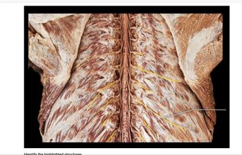 **Spinal Cord and Nervous System Dissection**

### Image Description

The image displays a detailed dissection of the spinal area, showcasing key anatomical structures. The focus is on the spinal cord and associated nerves.

**Highlighted Structures:**

- **Spinal Cord**: Centrally located, runs vertically through the image. It appears as a central column surrounded by muscle and tissue.
  
- **Nerves**: Highlighted in yellow, they branch out from both sides of the spinal cord. These nerves are part of the peripheral nervous system responsible for transmitting signals between the spinal cord and the rest of the body.

- **Muscles and Connective Tissue**: Surround the spinal cord and nerves, providing support and protection.

### Educational Focus

This image is useful for studying the anatomy of the spinal cord, understanding the layout of the nervous system, and the interaction between different types of tissues in the body.