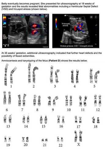 **Ultrasonography and Genetic Analysis in Prenatal Diagnosis**

*Fetal Abnormalities Detected in Early Pregnancy*

Betty, after becoming pregnant, underwent an ultrasonography at 18 weeks of gestation. The ultrasound results revealed significant fetal abnormalities, specifically a Ventricular Septal Defect (VSD) and tricuspid atresia.

**Ultrasound Analysis:**

- The left image displays two main structures: the left ventricle (LV) and the right ventricle (RV). There is an indication of a defect in the ventricular septum (VSD), which separates the left and right ventricles.
- The right image highlights additional abnormalities such as a hypoplastic right ventricle (RV) and tricuspid atresia. There is an indication of an atrial septal defect (ASD), specifically the ostium primum type, associated with tricuspid atresia.

*Further Findings Later in Pregnancy*

At 35 weeks of gestation, a subsequent ultrasound suggested additional heart defects and the possibility of flexed extremities.

*Genetic Analysis Through Amniocentesis*

Amniocentesis and karyotyping were performed on the fetus (referred to as Patient D), which produced the following chromosomal results:

**Karyotype Description:**

- The image depicts the chromosomes of Patient D, arranged in pairs from 1 to 22, along with the sex chromosomes, X.
- The karyotype appears to consist of normal pairs, indicating no apparent chromosomal abnormalities.

This case highlights the importance of comprehensive prenatal testing, combining ultrasonography with genetic analysis for early detection and management of fetal conditions.