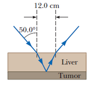 12.0 cm
50.0의
Liver
Tumor
