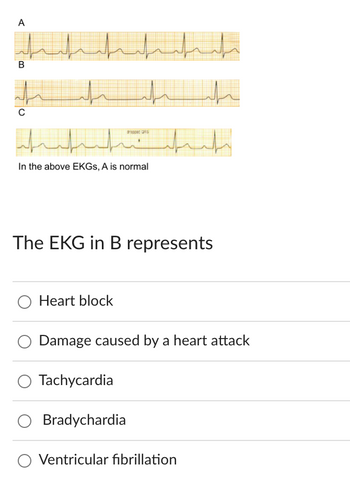 ## Understanding EKGs

The image displays three electrocardiograms (EKGs) labeled A, B, and C. 

### Descriptions

- **EKG A**: This EKG is indicated as normal. It shows a regular pattern of P waves, QRS complexes, and T waves, indicating a healthy cardiac rhythm.

- **EKG B**: This EKG exhibits a pattern that needs to be analyzed for potential cardiac anomalies.

- **EKG C**: This EKG includes an annotation indicating "dropped QRS," which suggests an irregularity where some QRS complexes are absent.

### Quiz

**The EKG in B represents:**

- ○ Heart block
- ○ Damage caused by a heart attack
- ○ Tachycardia
- ○ Bradycardia
- ○ Ventricular fibrillation

Use this information to determine what EKG B might represent by examining its pattern and considering the listed conditions.