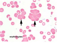 The image shows a microscopic view of erythrocytes, also known as red blood cells. These cells are primarily responsible for carrying oxygen throughout the body. The erythrocytes appear as pink, round bi-concave discs.

In the image, some of the erythrocytes are clumped together, a phenomenon known as rouleaux formation. This occurs when the cells stack together in a linear formation, resembling a stack of coins. Two black arrows point toward examples of rouleaux formation. This can be an indicator of certain medical conditions, including inflammation or increased plasma proteins.

Overall, the image provides a detailed view of erythrocytes in a sample, highlighting both individual erythrocytes and the rouleaux formation.