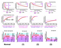 The image contains a series of graphs and spirometry test results relevant to pulmonary function testing.

### Top Row: Forced Expiration Graphs
1. **Normal Forced Expiration:**
   - The first graph shows a normal forced expiration curve.
   - FEV₁ (Forced Expiratory Volume in 1 second) = 4.0 L
   - FVC (Forced Vital Capacity) = 5.0 L
   - FEV₁/FVC ratio = 80%

2. **Forced Expiration with Obstruction:**
   - The next two graphs depict reduced FEV₁ and FEV₁/FVC ratios, indicating obstructive lung disease.
   - Second graph: FEV₁ = 1.2 L, FVC = 3.0 L, FEV₁/FVC = 40%
   - Third graph: FEV₁ = 2.7 L, FVC = 3.0 L, FEV₁/FVC = 90%

### Middle Row: Compliance Curves
1. **Normal Compliance Curve:**
   - Total Lung Capacity (TLC) = 6 L
   - Residual Volume (RV) = 2 L

2. **Increased Compliance Curve:**
   - Indicates an increase in lung compliance, suggesting emphysema.
   - TLC = 6.5 L, RV = 3 L
   - "Same as normal; 15 most distensible., as it often seen in emphysema."

3. **Decreased Compliance Curve:**
   - Reflects decreased lung compliance, characteristic of restrictive lung disease.
   - TLC = 3 L, RV = 1 L

### Bottom Row: Spirograms
1. **Normal Spirogram:**
   - Shows normal inspiratory and expiratory volumes.
   - Includes:
     - IRV (Inspiratory Reserve Volume)
     - TV (Tidal Volume)
     - ERV (Expiratory Reserve Volume)
     - RV (Residual Volume)

2. **Spirograms with Abnormal Patterns:**
   - Each spirogram demonstrates different pathological patterns of lung volume distribution.

   - (1): Similar to normal, possibly obstructive pattern.
   - (2): Shows reduced IRV and ERV, suggesting restricted lung volumes.
   - (3): Greatly reduced IRV, ERV, and overall volume, typical of significant restrictive