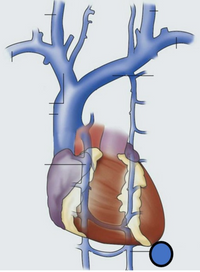 The image displays a detailed diagram of the human heart and its associated major blood vessels, highlighting the anatomy of the circulatory system. 

### Key Components:

1. **Heart**: Positioned slightly to the left of the center of the chest, the heart is depicted with its chambers and major structures. It is shown encased by layers of fibrous tissue, an indication of the heart's complex structure.

2. **Arteries**: Arteries are shown branching from the heart, illustrated in blue. These vessels carry oxygenated blood from the heart to various parts of the body. The prominent artery visible could represent the aorta, the largest artery in the human body.

3. **Veins**: The veins are portrayed in purple and represent blood vessels that return deoxygenated blood to the heart. They include the superior vena cava and inferior vena cava, which are the main veins connecting to the heart.

4. **Pulmonary Vessels**: These vessels connect the heart to the lungs, facilitating the exchange of gases. The pulmonary artery and veins are particularly emphasized.

5. **Labeled Sections**: Various parts of the circulatory system are annotated with lines indicating key structural features. However, specific names are not provided, meaning the image serves as a general educational tool rather than a labeling exercise.

The circular blue object at the bottom right possibly serves as an annotation feature or artistic element, not directly relevant to anatomical structures.

Overall, this diagram is an educational tool for understanding the basic anatomy of the cardiovascular system, focusing on the heart's role in blood circulation.