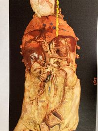 The image displays a dissected view of the thoracic region, particularly focusing on the cardiovascular structures within the mediastinum. 

Key features labeled include:

- **Heart within the mediastinum**: This is the central compartment of the thoracic cavity, surrounded by the chest organs but excluding the lungs. The heart is housed in this region.
- **Anatomical structures**: Visible structures include the major vessels and nerves connected to the heart. 

The image serves as an educational tool for understanding the anatomical placement and the relationship among the heart and surrounding structures in the mediastinal region. This provides insight into how the heart is positioned relative to other thoracic organs and its connection through major arteries and veins.