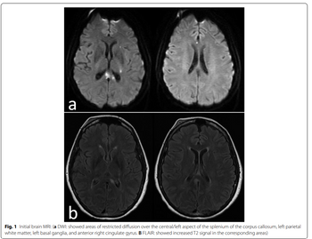 a
b
Fig. 1 Initial brain MRI: (a DWI: showed areas of restricted diffusion over the central/left aspect of the splenium of the corpus callosum, left parietal
white matter, left basal ganglia, and anterior right cingulate gyrus. B FLAIR: showed increased T2 signal in the corresponding areas)