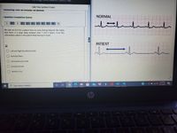 CRN:2
Take Test: Section 3 Exam
kemaining Time: 40 minutes, 30 seconas.
* Question Completion Status:
NORMAL
100
11
We take an ECG for a patient that has been feeling fatigued. We notice
that there is a large delay between their I and P waves. From this
information, where is this patient likely having an issue?
PATIENT
ルー
Left and Right Bundle Branches
O Purkinje Fibers
Atrioventricular Node
Sinoatrial Node
Bundle of His
noints
6:04 PM
4/17/2021
10
PType here to search
Chp
tyo
24
A O O O OO
