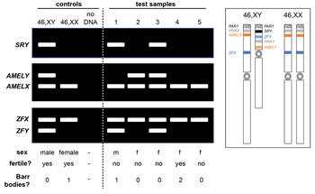SRY
AMELY
AMELX
ZFX
ZFY
controls
Barr
bodies?
no
46,XY 46,XX DNA
sex
male female
fertile? yes yes
0 1
1
3
no
1
test samples
2
3
no
f f f
yes
4
no
5
f
no
0 0 2 0
PAR1
PRKX
AMELX
ZFX
46,XY
ol
PAR1
SRY
ZFY
PRKY
AMELY
46,XX
T
||
OO