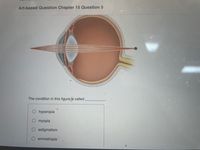 Art-based Question Chapter 15 Question 5
The condition in this figure is called
hyperopia
myopia
astigmatism
emmetropia
