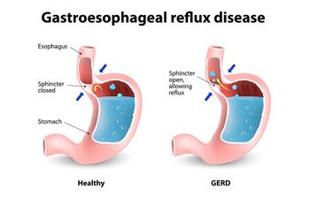 Answered Gastroesophageal reflux disease bartleby