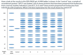 Have a look at the results in this SDS-PAGE gel. A MW ladder is shown. In the "control" lane, a sample of
recombinant protein "LBT3" was loaded. Lane A shows proteins that have been prepared from leukocytes
from a normal, healthy individual. Lanes B, C, D, E and F show protein prepared from leukocytes from
individuals with lymphoma. What is the best explanation for the result shown for patient D?
200
150
100
75
50
37
20
Weight,
kDa
MW
ladder
Control
A