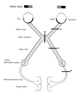 Answered: (right eye is represented on the right… | bartleby