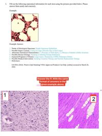 Fill out the following anatomical information for each item using the pictures provided below. Please
answer them neatly and concisely.
I.
Example:
Example Answer:
1. Name of Histological Specimen: Simple Squamous Epithelium
2. Possible Organ Location: Lining of Lungs (Alveolar Sacs of the Lungs)
3. Abnormal Anatomical Characteristics: (+) Presence of Dark Spots, (-) Absence of distinct cellular structures
4. Possible Disease Etiology: Smoking or Inhaling Foreign Substances
5. Expected Prognosis of Disease: Lung Cancer. Pneumonia, COPD, Pulmonary Edema
6. Possible Medical Intervention: Smoking Cessation Therapy and Nicotine Replacement Therapy
7. References:
US FDA (2022). Want to Quit Smoking? FDA-Approved Products Can Help. [online] accessed at March 26,
2022.
Answer the ff. With the same
format of answers in the
given example above.
1
2
