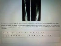 A child has come into the ER with a broken arm and upon taking an X-Ray you have
scovered that both bones of the
forearm are broken, but closed. The child's parents are extremely concerned about future growth as this child gets older.
Explain to the parents about the healing process and predict if there will be any issues with the growth plate as the child
gets older.
三
X2
x2
#3
</>
四
四
囲
