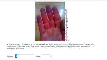 ### Cyanosis: An Indicator of Hypoxemia

**Image Description:** The image shows a person's open hand with visible blue/purple coloration on the skin of the fingers and palm. This is indicative of a condition known as cyanosis.

**Explanation:**
Cyanosis is a common sign of hypoxemia, or low oxygen levels in the blood, which results in a noticeable blue or purple discoloration of the skin. This is often observed in peripheral areas like the fingers, toes, and lips. The change in color is due to an increased concentration of deoxygenated hemoglobin in the blood.

**Interactive Section:** 
- **Number [Info Icon] [Input Box]**
- **Units [Dropdown Menu]**

This input function allows users to log or calculate related metrics, possibly for educational purposes or tracking symptoms.