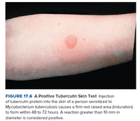 positive mantoux skin test