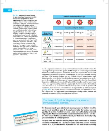 248
Case 44: Hemolytic Disease of the Newborn
Fig. 44.1 Hemagglutination is used
to type blood and match compatible
donors and recipients for blood
transfusion. Common gut bacteria bear
antigens that are similar or identical to
blood group antigens, and these stimulate
the formation of antibodies against
these antigens in individuals who do not
bear the corresponding antigen on their
own red blood cells (left column); thus,
type O individuals, who lack A and B
antigens, have both anti-A and anti-B
antibodies, whereas type AB individuals
have neither. The pattern of agglutination
of the red blood cells of a transfusion
donor or recipient with anti-A and anti-B
antibodies reveals the individual's ABO
blood group. Before transfusion, the
serum of the recipient is also tested for
antibodies that agglutinate the red blood
cells of the donor, and vice versa, a
procedure called a cross-match, which
may detect potentially harmful antibodies
against other blood groups that are not
part of the ABO system.
30.5 weeks: hematocrit up to
16.3% Further transfusion
requested.
Serum from
individuals of type
Anti-A and anti-B
antibodies
Anti-B antibodies
B
Anti-A antibodies
AB
No antibodies
against A or B
R-GlcNAc-Gal
Fue
no agglutination
no agglutination
no agglutination
no agglutination
Red blood cells from individuals of type
Express the carbohydrate structures
R-GlcNAc-Gal-GalNAc R-GlcNAc-Gal-Gal
Fúc
Ric
agglutination
no agglutination
agglutination
no agglutination
agglutination
agglutination
no agglutination
no agglutination
R-GlcNAc-Gal-GaNAC
3-2.3-2
R-GNA-Gal-Gal
agglutination
agglutination
agglutination
no agglutination
The Rh antigenic determinants are spaced very far apart on the red cell surface. As
a consequence, IgG antibodies against the Rh antigen do not fix complement and
therefore do not hemolyze red blood cells in vitro. For reasons that are less well
understood, IgG antibodies against the Rh antigen do not agglutinate Rh-positive
red blood cells. Because of this it was very difficult to detect Rh antibodies until
Robin Coombs at the University of Cambridge devised a solution to the prob-
lem by developing antibodies against human immunoglobulin. He showed that
Rh-positive red blood cells coated with IgG anti-Rh antibodies could be taken from
a fetus and agglutinated by antibodies against IgG. Furthermore, he showed that
when the serum of an alloimmunized woman was incubated with Rh-positive red
blood cells, these red blood cells could then be agglutinated by antibody against
IgG (Fig. 44.2). The former is called the direct Coombs test and the latter the indi-
rect Coombs test. This application of immunology to a vexing clinical problem led
ultimately to treatment and prevention of the problem.
The case of Cynthia Waymarsh: a fetus in
immunological distress.
Mrs Waymarsh was 31 years old when she became pregnant for the third time. She
was known to have blood group A, Rh-negative red cells. Her husband was also
type A but Rh-positive. Their first-born child, a male, was healthy. During her second
pregnancy Mrs Waymarsh was noted to have an indirect Coombs titer at a 1:16 dilu-
tion of her serum. The fetus was followed closely, and the delivery of a healthy baby
girl was induced at 36 weeks of gestation.
Five years later, Mrs Waymarsh became pregnant again. At 14 weeks of gestation
her indirect Coombs titer was 1:8, and at 18 weeks it was 1:16. Amniotic fluid was
obtained at 22, 24, 27, and 29 weeks of gestation and was found to have increasing