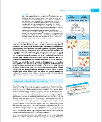 Case 44: Hemolytic Disease of the Newborn
Fig. 44.2 The Coombs direct and indirect anti-globulin tests for
antibody to red blood cell antigens. An Rh-negative (Rh-) mother of an
Rh-positive (Rh+) fetus can become immunized to fetal red blood cells
that enter the maternal circulation at the time of delivery. In a subsequent
pregnancy with an Rh+ fetus, IgG anti-Rh antibodies can cross the
placenta and damage the fetal red blood cells. In contrast to anti-Rh
antibodies, anti-ABO antibodies are of the IgM isotype; they cannot
cross the placenta, and so do not cause harm. Anti-Rh antibodies do not
agglutinate red blood cells, but their presence can be shown by washing
the fetal red blood cells and then adding antibody against human
immunoglobulin, which agglutinates the antibody-coated cells. The
washing removes unrelated immunoglobulins that would otherwise react
with the anti-human immunoglobulin antibody. Anti-Rh antibodies can be
detected in the mother's serum in an indirect Coombs test; the serum is
incubated with Rh+ red blood cells, and once the antibody has bound,
the red cells are treated as in the direct Coombs test.
amounts of bilirubin (a pigment derived from the breakdown of heme, indicating
that the fetus's red blood cells were being hemolyzed). At 29 weeks of gestation a
blood sample was obtained from the umbilical vein and found to have a hematocrit
of 6.2% (normal 45%). (The hematocrit is the proportion of blood that is composed
of red cells, and because the volume of white cells is comparatively negligible, this
is simply ascertained by centrifuging whole unclotted blood in a tube.) On finding
that the fetus was profoundly anemic, 85 ml of type 0, Rh-negative packed red blood
cells were transfused into the umbilical vein. At 30.5 weeks of gestation another
sample of blood from the umbilical vein was obtained; the hematocrit was 16.3%.
The etus was transfused with 75 ml of type 0, Rh-negative packed red blood cells.
The fetus was examined at weekly intervals for the appearance of hydrops (see
below), and none was observed. At 33.5 weeks of gestation, the hematocrit of a
blood sample from the umbilical vein was 21%, so 80 ml of type 0, Rh-negative
packed red blood cells were again transfused into the umbilical vein. At 34.5 weeks
of gestation it was determined that the fetus was sufficiently mature to sustain
extrauterine life without difficulty; labor was induced and a normal female infant
was born. The hematocrit in the umbilical vein blood was 29%. The baby did well
and no further therapeutic measures were undertaken.
Hemolytic disease of the newborn.
Although hemolytic disease of the newborn is most commonly the result of alloim-
munization with Rh antigen, other red blood cell alloantigens, such as Lewis, Kell,
Duffy, Kidd, and Lutheran, may cause alloimmunization. In each case, the mater-
nal IgG antibodies cross the placenta in increasing amounts during the second tri-
mester of pregnancy and hemolyze the fetal red blood cells. The resulting anemia
may become so severe that, if untreated, the fetus goes into heart failure and devel-
ops massive edema; this is called hydrops fetalis and results in fetal death. The risk
of fetal development of hydrops rises from 10% when the indirect Coombs titer of
the mother is 1:16 to 75% when the maternal titer is 1:128. If the anemia is not so
severe as to cause hydrops, the affected infant at birth is still massively hemolyz-
ing red blood cells. The newborn must dispose of the heme breakdown pigments
rapidly, because an excessive accumulation of bilirubin results in the deposition of
this pigment in the brain and severe neurological impairments. In response to the
profound anemia, the number of red blood cell precursors (erythroblasts) in the
spleen, liver, and bone marrow expands rapidly; for this reason, hemolytic disease
of the newborn has also been called erythroblastosis fetalis.
As we have seen in this case, the extent of hemolysis can be determined easily
by obtaining amniotic fluid, into which the fetus begins to urinate by 20 weeks of
Direct
Coombs test
Indirect
Coombs test
Rh- mother pregnant with Rh+ child
(Rh*
Washed fetal red
cells coated with
maternal antibody
Add rabbit
anti-human antibody
Rh
Maternal
serum
Add Rh+ red cells
and wash out
unbound antibody
Agglutination
Add rabbit
anti-human antibody
33.5 weeks: hematocrit up
to 21%. Further transfusion
requested.
249