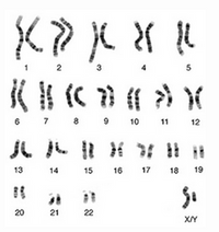 This image is a karyotype, a visual representation of the chromosomes in a human cell. Chromosomes are shown in pairs, numbered from 1 to 22, and ordered by size. The final pair is labeled as X/Y, indicating the sex chromosomes, where the presence of both an X and a Y chromosome typically indicates a male karyotype. Each chromosome has a unique banding pattern that helps in identifying them. This pattern is produced by staining techniques used during chromosome preparation. Karyotypes are used in genetics to study chromosomal abnormalities and other genetic characteristics.