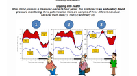 Dipping into health
When blood pressure is measured over a 24-hour period, this is referred to as ambulatory blood
pressure monitoring, three patterns arise. Here are samples of three different individual.
Let's call them Dick (1), Tom (2) and Harry (3).
1
2
Patient's
BP
Paient's
BP
Pationt's
BP
190
13
Upper
limit
Uper
limit
Lpper
limit
124
II
Loner
limit
Loner
limit
Lower
limit
12
Time (hours after awakening)
Time (hours afler awakening)
Time (hours afer awakening
3.
(H ) rIOISAS
