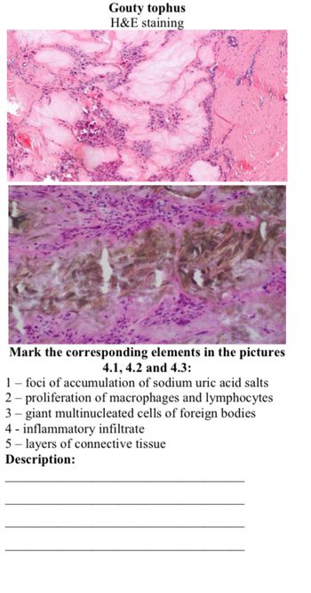 Gouty tophus
H&E staining
Mark the corresponding elements in the pictures
4.1, 4.2 and 4.3:
1- foci of accumulation of sodium uric acid salts
2- proliferation of macrophages and lymphocytes
3-giant multinucleated cells of foreign bodies
4- inflammatory infiltrate
5- layers of connective tissue
Description: