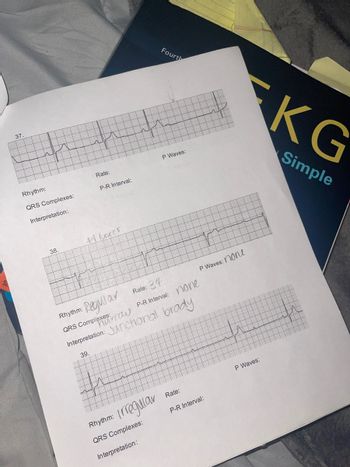 ### Educational Website Content on EKG Interpretation

---

#### EKG Interpretation Practice

The document represents a series of EKG strips numbered 37, 38, and 39. Each strip is accompanied by specific criteria for interpretation, including rhythm, rate, QRS complexes, P waves, P-R interval, and an interpretation field. Here is a detailed walkthrough of each EKG strip:

#### EKG Strip 37
- **Rhythm:** (Information not provided)
- **Rate:** (Information not provided)
- **P Waves:** (Information not provided)
- **QRS Complexes:** (Information not provided)
- **P-R Interval:** (Information not provided)
- **Interpretation:** (Information not provided)

#### EKG Strip 38
- **Rhythm:** Regular
- **Rate:** 34
- **P Waves:** None
- **QRS Complexes:** Narrow
- **P-R Interval:** None
- **Interpretation:** Junctional Brady

#### EKG Strip 39
- **Rhythm:** Irregular
- **Rate:** (Information not provided)
- **P Waves:** (Information not provided)
- **QRS Complexes:** (Information not provided)
- **P-R Interval:** (Information not provided)
- **Interpretation:** (Information not provided)

### Explanation of Terms

1. **Rhythm:** This refers to the regularity or pattern of the heartbeats.
   - **Regular Rhythm:** Heartbeats occurring at regular intervals.
   - **Irregular Rhythm:** Heartbeats occurring at irregular intervals.

2. **Rate:** The speed of the heart rhythm, typically expressed in beats per minute (bpm).

3. **P Waves:** These signify atrial depolarization. The presence or absence of P waves can indicate various types of heart activities or issues.

4. **QRS Complexes:** Represent ventricular depolarization. Their shape and duration can indicate normal or abnormal conduction through the ventricles.
   - **Narrow QRS:** Indicates that the ventricular depolarization is occurring rapidly through the normal pathways.

5. **P-R Interval:** Time interval between the onset of atrial depolarization and the onset of ventricular depolarization. 

6. **Interpretation:** The analysis and diagnosis based on the observed characteristics in the EKG strip.

### Graph Explanations

The EKG strips are graphical representations of electrical activity in the heart over time. Each small square on the