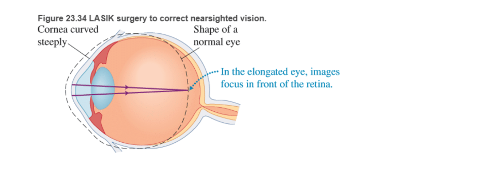 Chapter 23, Problem 83RPP, BIO Laser surgery for the eye LASIK (laser-assisted in situ keratomileusis) is a surgical procedure , example  1
