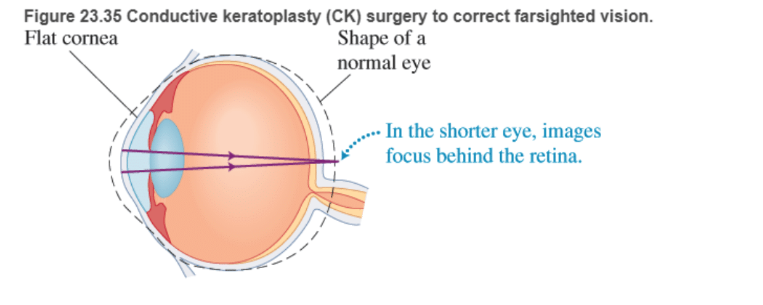 Chapter 23, Problem 83RPP, BIO Laser surgery for the eye LASIK (laser-assisted in situ keratomileusis) is a surgical procedure , example  2