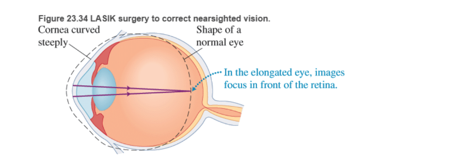 Chapter 23, Problem 84RPP, BIO Laser surgery for the eye LASIK (laser-assisted in situ keratomileusis) is a surgical procedure , example  1