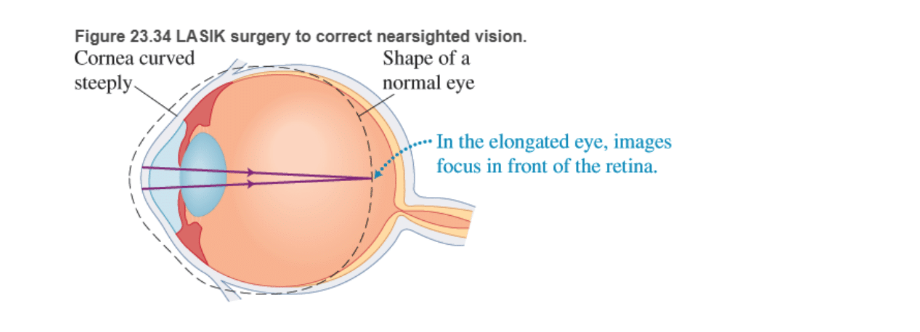 Chapter 23, Problem 85RPP, BIO Laser surgery for the eye LASIK (laser-assisted in situ keratomileusis) is a surgical procedure , example  1