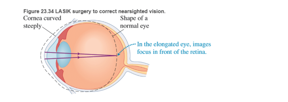 Chapter 23, Problem 86RPP, BIO Laser surgery for the eye LASIK (laser-assisted in situ keratomileusis) is a surgical procedure , example  1