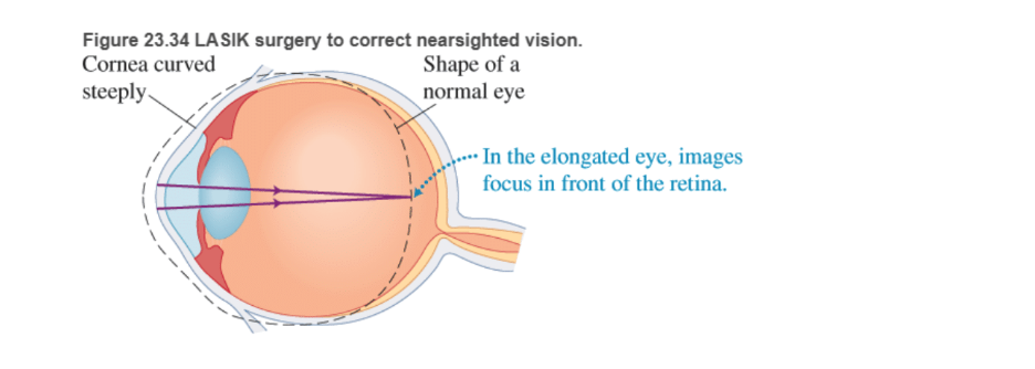 Chapter 23, Problem 87RPP, BIO Laser surgery for the eye LASIK (laser-assisted in situ keratomileusis) is a surgical procedure , example  1