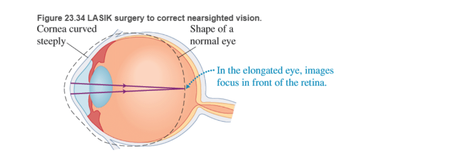 Chapter 23, Problem 88RPP, BIO Laser surgery for the eye LASIK (laser-assisted in situ keratomileusis) is a surgical procedure 