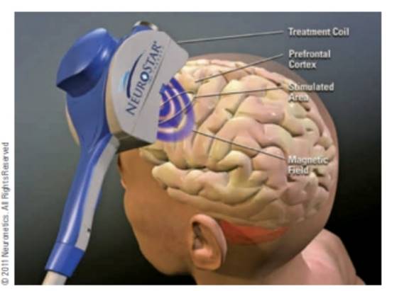 Chapter 31, Problem 31.3P, Transcranial magnetic stimulation (TMS) is a noninvasive technique used to stimulate tedious of the 