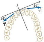 Chapter 5, Problem 5.1P, A certain orthodontist uses a wire brace to align a patients crooked tooth as in Figure P5.1. The 